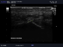 Ultrazvok pete - trn v peti - spina calcanea